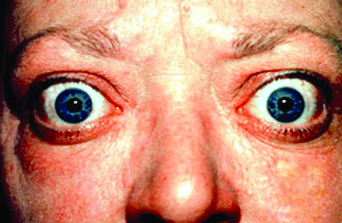 Grave’s Disease, a major cause of hyperthyroidism