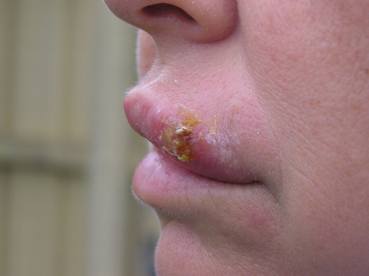 Herpes Simplex, FAQs