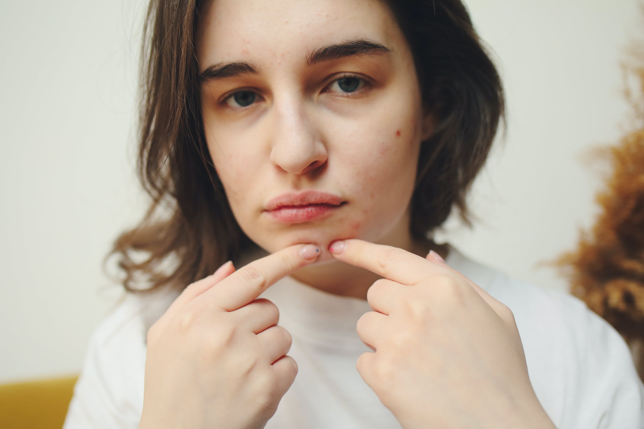 A young woman popping a pimple on her chin