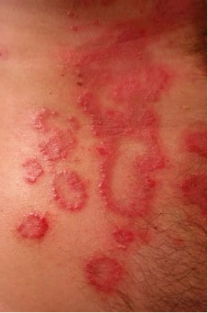 skin with red patches