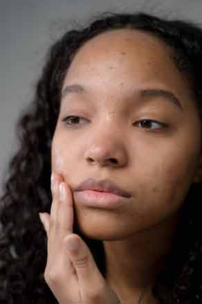 acne-on-girls-face
