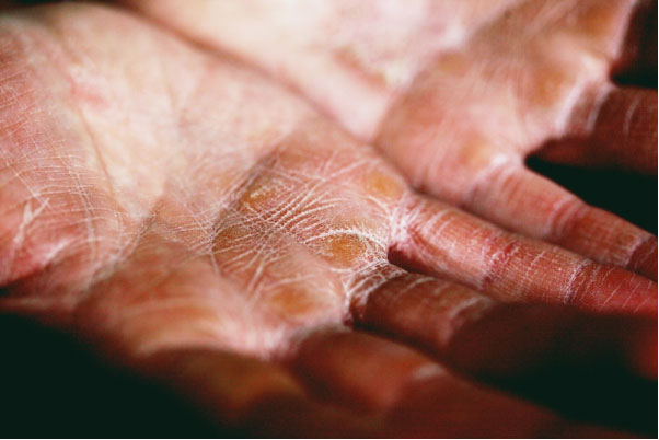 eczema